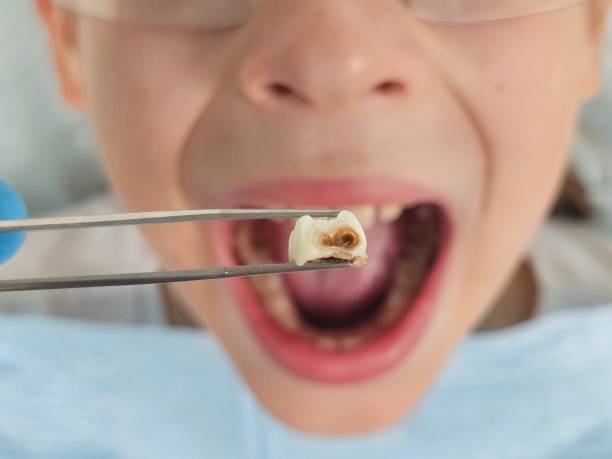 Best Broken or Chipped Tooth Repair in Siesta Shores, TX